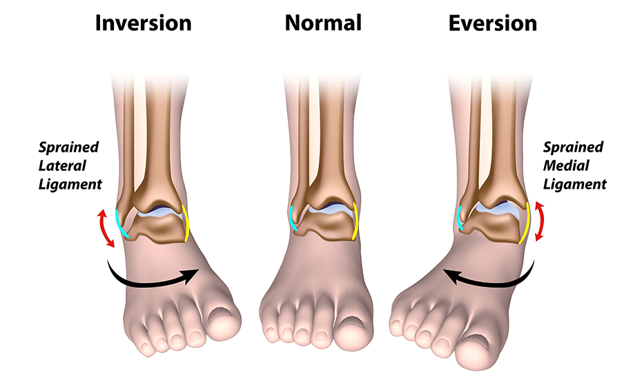 artroza articulațiilor piciorului este