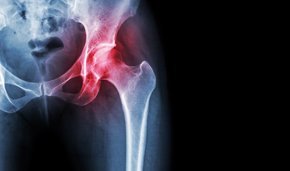 fesă durere în interiorul articulației tratamentul artrozei genunchiului cu injecții de acid hialuronic