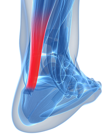 Simptomele de afectare a tendoanelor de șold artroza deformantă a tratamentului dietei genunchiului