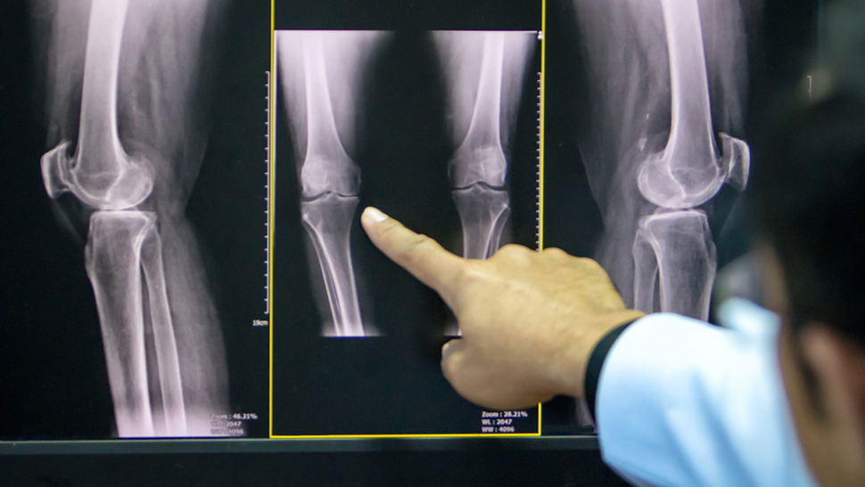 Artroza acută a articulației gleznei. Cum pot fi diminuate durerile provocate de artroză