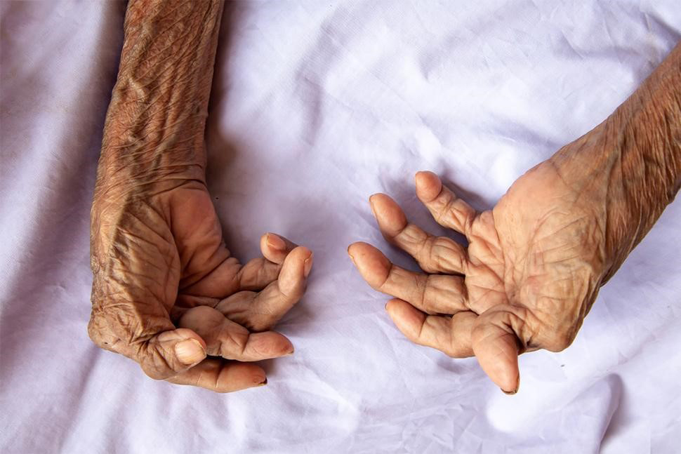 tratamentul artritei posttraumatice a degetului