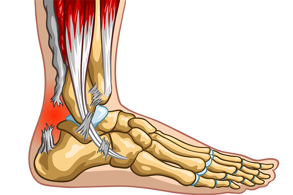 tratamentul aterosclerozei genunchiului cauza durerii de umăr și medicamente