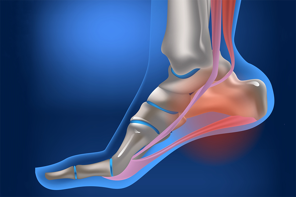 dureri articulare călcâiului osteoartrita deformatoare a articulației genunchiului tratament de 1 grad