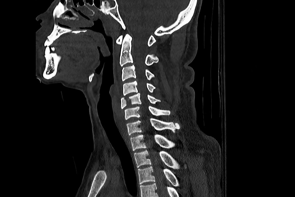 Fractura cervicala: simptome, cat dureaza vindecarea | Kinetic.ro